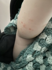 Baby rash