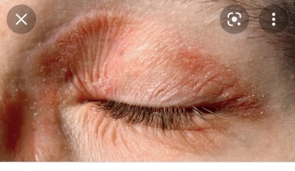 Please help me identify this rash