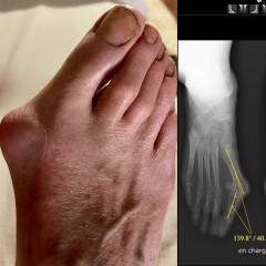 Post op bunion removal