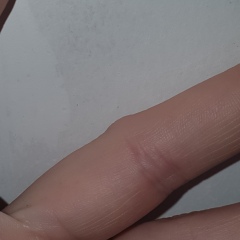 Anyone good at identifying weird finger bumps? 