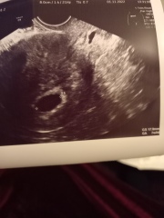 Trying to cope with late miscarriage at 18 weeks😪 