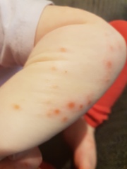 Chickenpox 