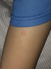 Could this be ringworm? 