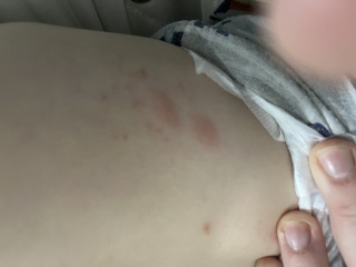 CP of bed bugs or another bite!?  