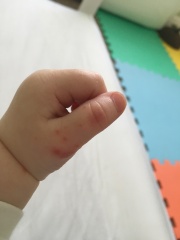 Hand food and mouth or chicken pox - second opinion?
