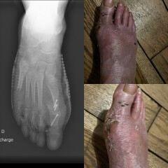 Post op bunion removal