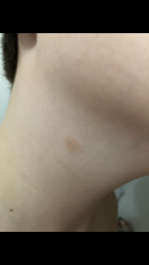 Could this be ringworm? 