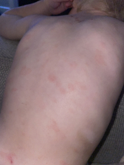 Is this really ringworm?