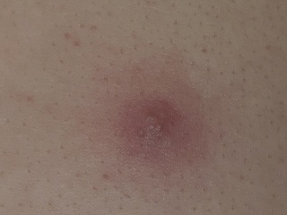 Spot on ds (23 yr) back - photo