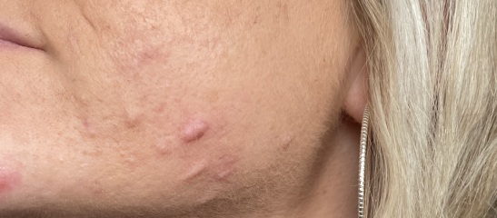 Pics of my scarred face ! Spots