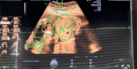Recorded Video While Anomaly Scan