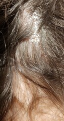 Build up of dry skin on base of the head (photo)