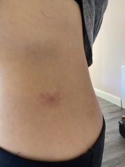 Worrying that this is a tick bite?