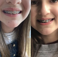 Twin Block Braces - Any Advice?