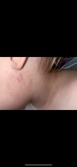 Is this really ringworm?