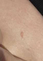 Suspicious mark on skin