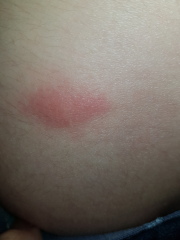 To ask what's biting me? 