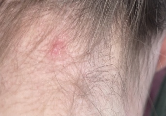 Could this be skin cancer?