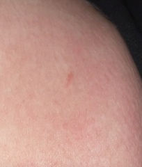 Suspicious mark on skin