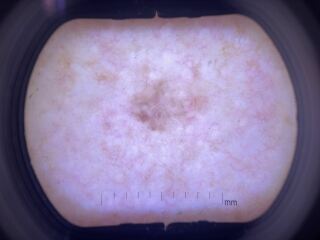 Suspicious mole, being referred on a 2 week pathway