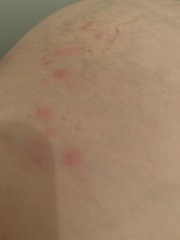 Shingles?