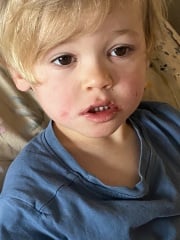 In a panic re scarlet fever (pic)