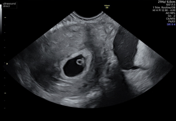 Cramping and spotting 5 weeks 