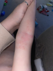 Is this really ringworm?