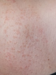 Please help me identify this rash