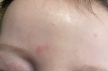 Baby rash help (photos)