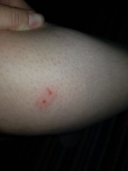 To ask what's biting me? 