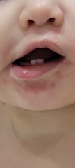 Early hand foot and mouth?