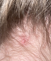 Could this be skin cancer?