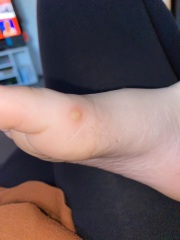 Spot on 7 year olds foot