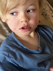 In a panic re scarlet fever (pic)