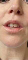 White coated lips and burning - causing anxiety 