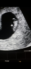 IVF warriors - journey continues