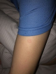 Could this be ringworm? 