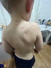 ? chicken pox ?