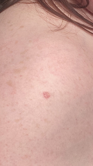 Little skin growth