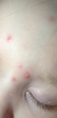 *PHOTO WARNING*Do these look like normal chicken pox?