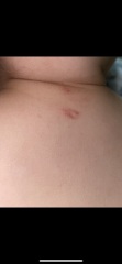 Is this really ringworm?