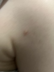 ? chicken pox ?