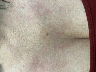 Suspicious mole, being referred on a 2 week pathway