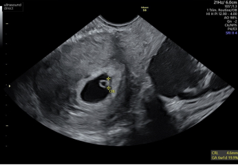 Cramping and spotting 5 weeks 