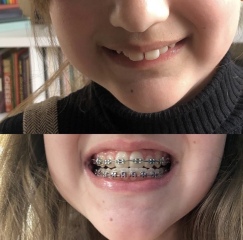 Twin Block Braces - Any Advice?