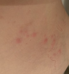 Shingles?