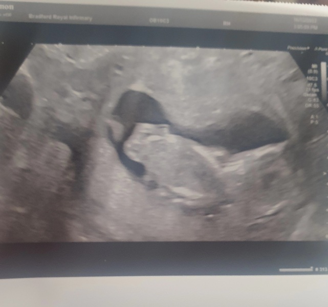 12 week scan