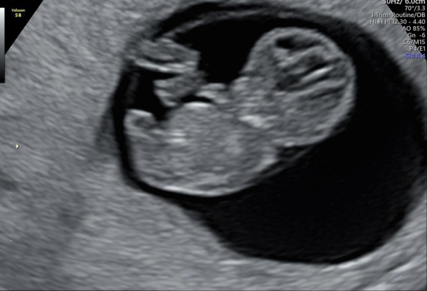 Pregnant after ivf - 5 weeks 