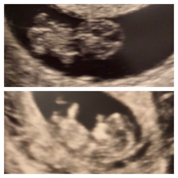 Pregant after miscarriage - support thread